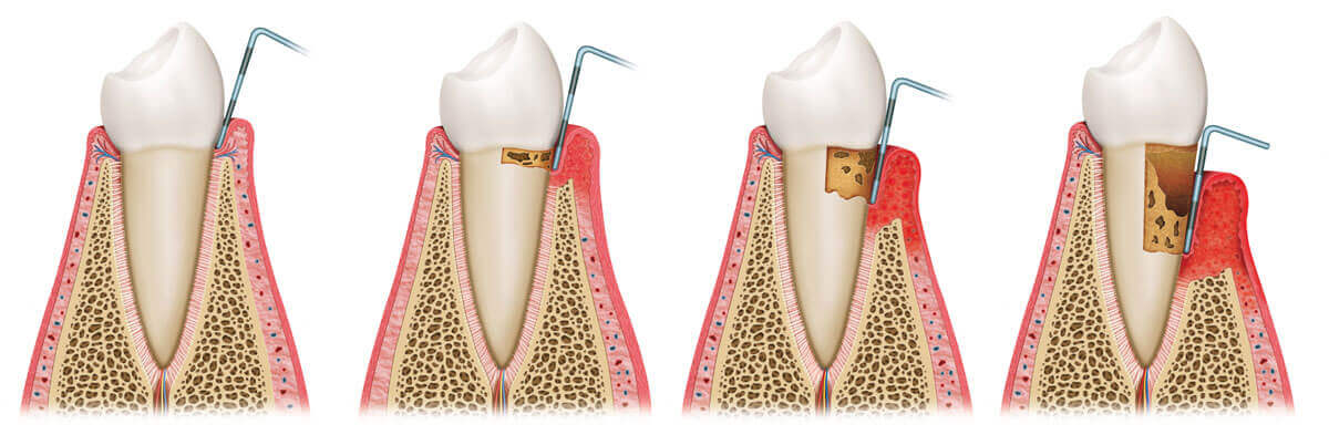 Periodontal Surgery