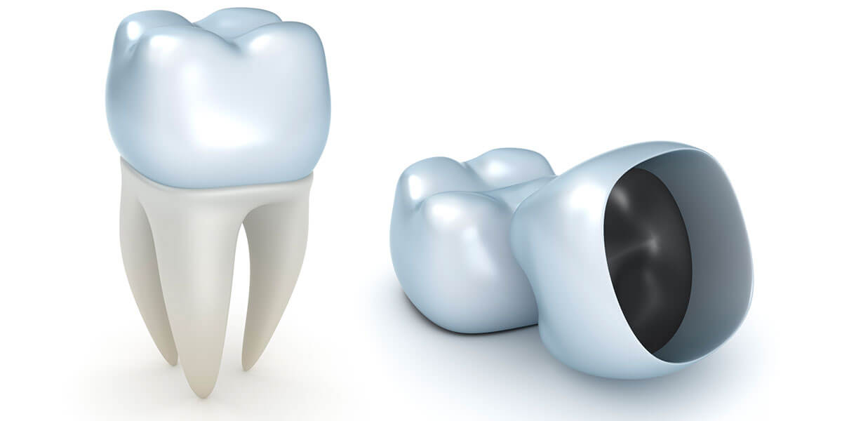 Cad cam restoration image