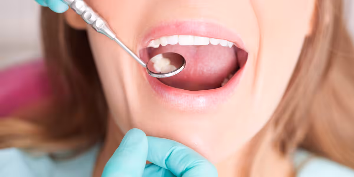 Closeup of filling with dental mirror