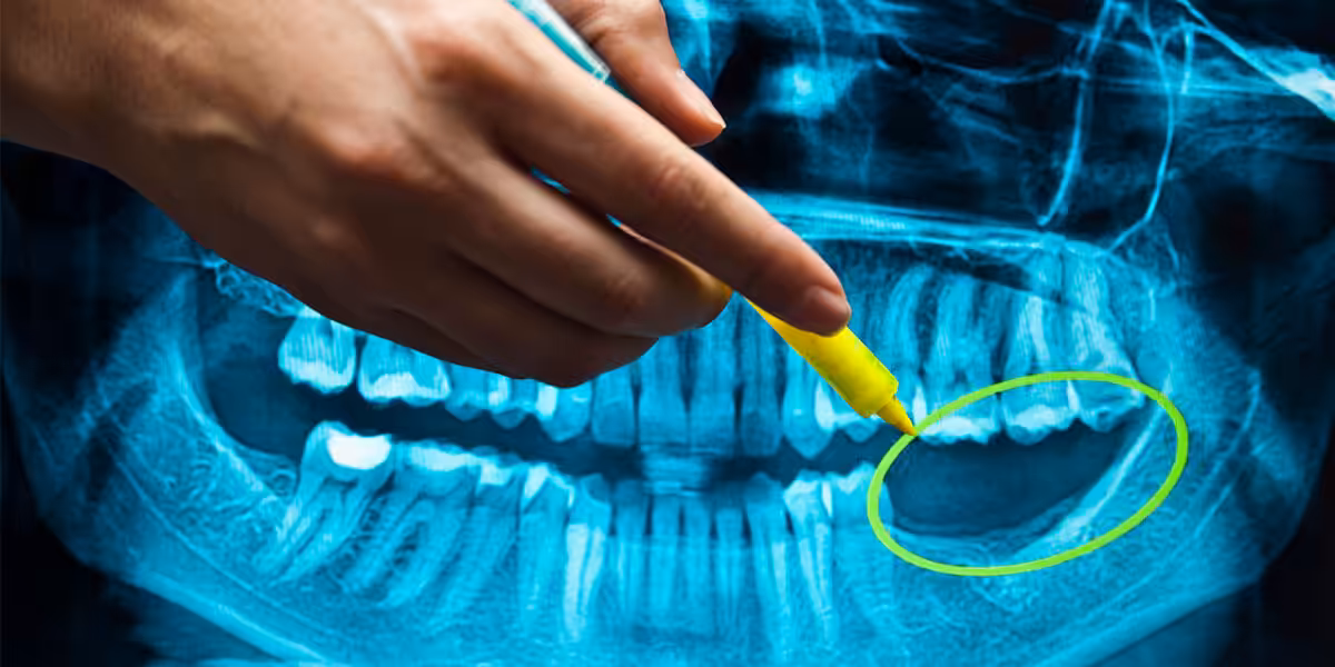 Dental implant benefits