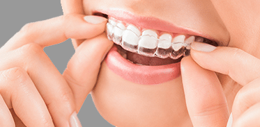 Invisalign button